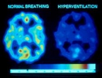 brain scan of hyperventilation