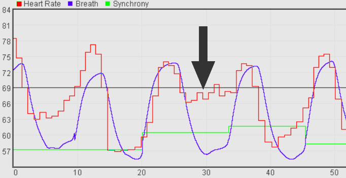loss of heart coherence